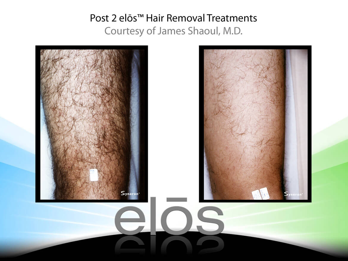 Elos-Morif-Laser-Hair-3